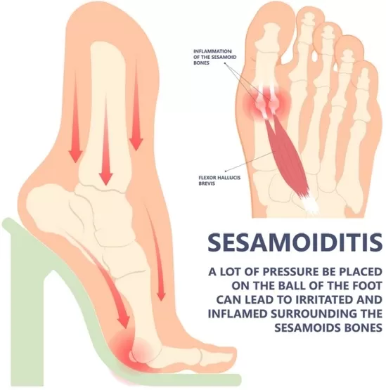 Advanced Treatment Options for Sesamoiditis and Accessory Ossicle Pain