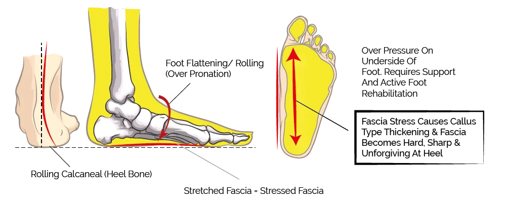 flattening arches and plantar fasciitis