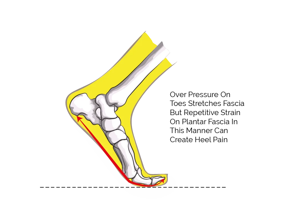 forefoot running and plantar fasciitis the causes