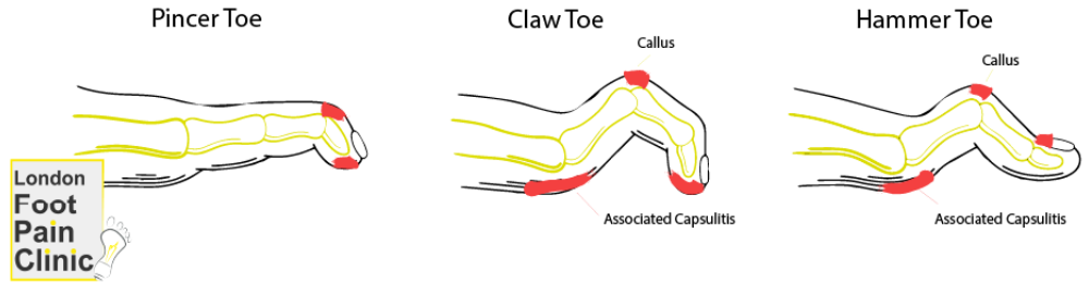 What is Hammer Toes & Treatment Options Wimbledon